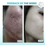 Derma Roller.webp Derma Roller.webp
