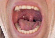 tonsil-stone-1.webp