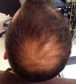 Alopecia.webp Alopecia.webp