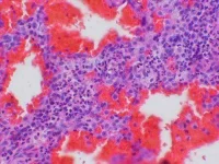 Allergy-Yale-Rosen-e1424773531170.webp Allergy-Yale-Rosen-e1424773531170.webp