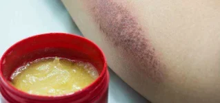 Efficient-Home-Remedies-For-Burns.webp Efficient-Home-Remedies-For-Burns.webp