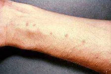 290px-Schistosomiasis_itch.webp