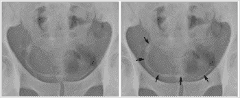 350px-Schistosomiaisis_Bladder_Calcifications.webp