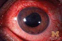 220px-Anterior-uveitis.webp 220px-Anterior-uveitis.webp