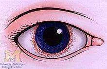220px-Ciliary-flush.webp 220px-Ciliary-flush.webp