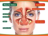 Sinus-Infection.webp Sinus-Infection.webp