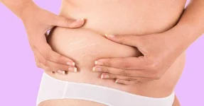 3-Natural-Ways-to-Protect-Against-Stretch-Marks.webp
