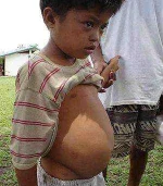 300px-Schistosomiasis_in_a_child_2.webp