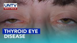 Thyroid Eye Disease: Autoimmune Disorder Affecting the Eyes Thyroid Eye Disease: Autoimmune Disorder Affecting the Eyes