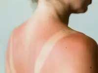 sunburn-732x549-thumbnail-732x549.webp sunburn-732x549-thumbnail-732x549.webp