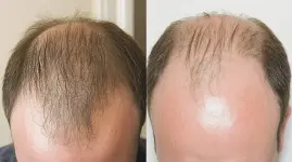 Stages-of-male-pattern-baldness-1024x573.webp Stages-of-male-pattern-baldness-1024x573.webp