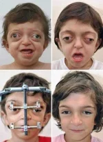 Crouzon Syndrome.webp Crouzon Syndrome.webp
