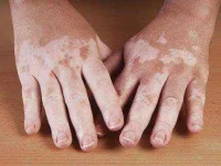 06-eye-color-vitiligo-sl.webp