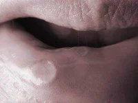 09-men-cancer-signs-mouth-sore-sl.webp 09-men-cancer-signs-mouth-sore-sl.webp