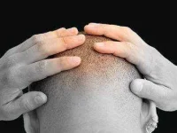 bald-sl.webp