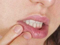 18-coconut-oil-cold-sore-sl.webp 18-coconut-oil-cold-sore-sl.webp