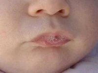 17-coconut-oil-baby-thrush-sl.webp 17-coconut-oil-baby-thrush-sl.webp