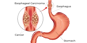 GERD-esophogeal-cancer-diagram.png
