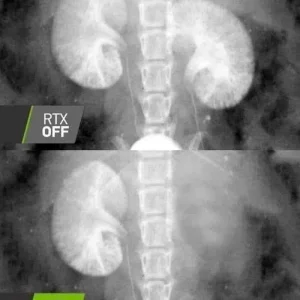 rtx=kidney.jpeg